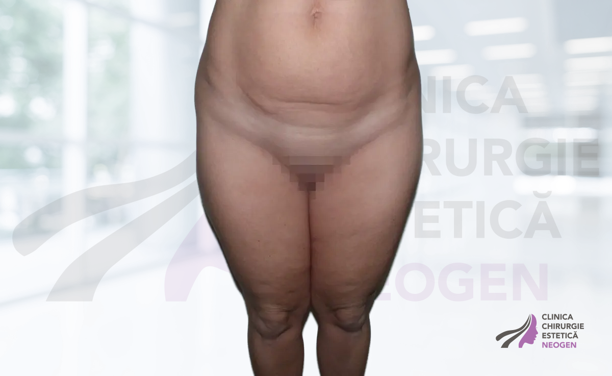 Lipoaspiraţie Înainte