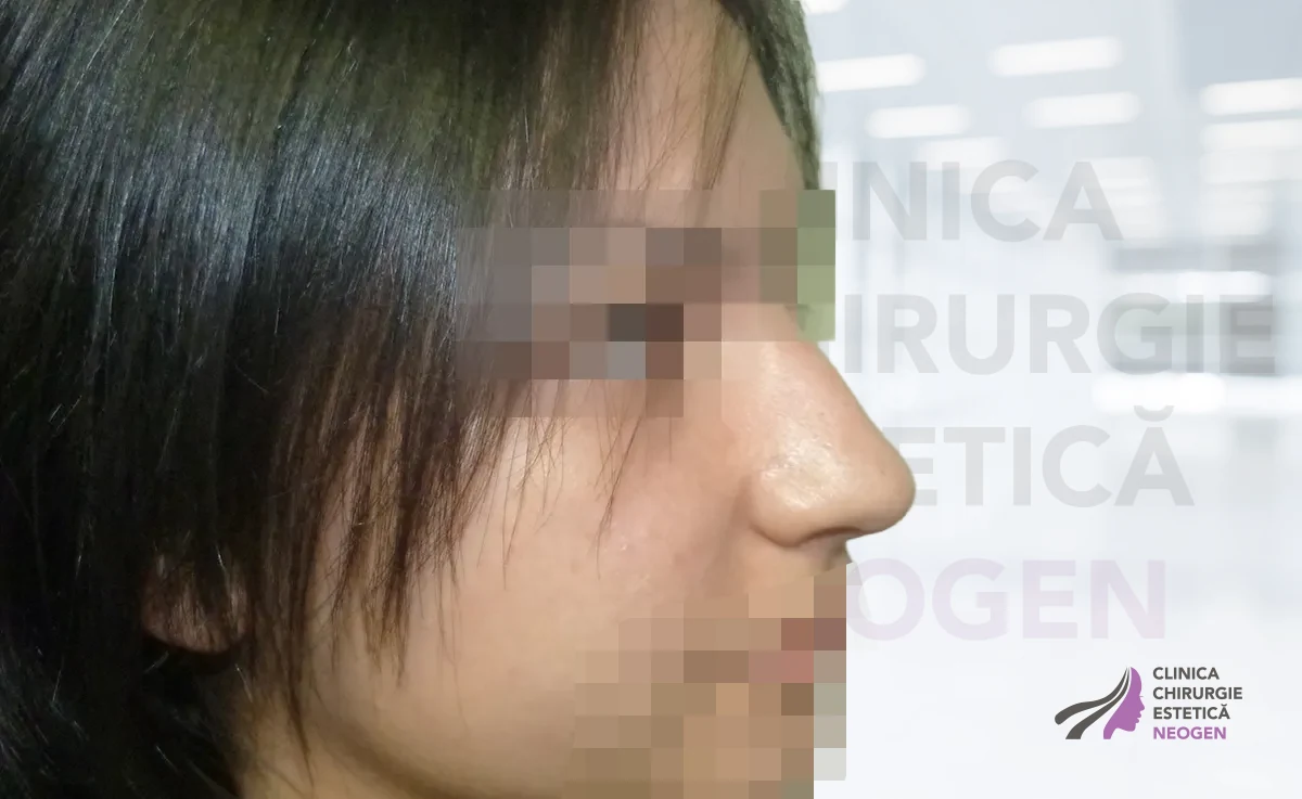 Rinoplastie Înainte