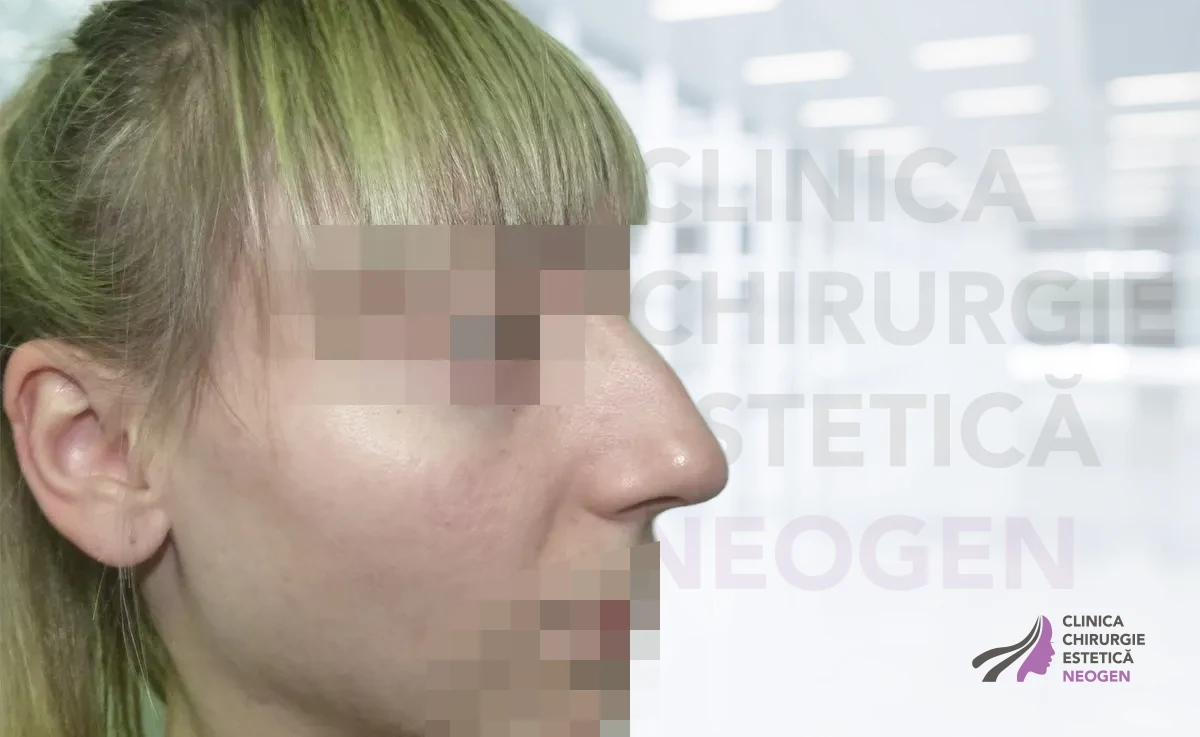 Rinoplastie Înainte