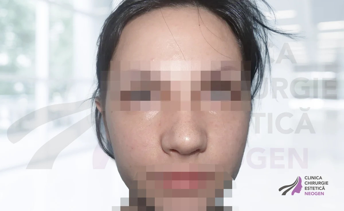 Rinoplastie După