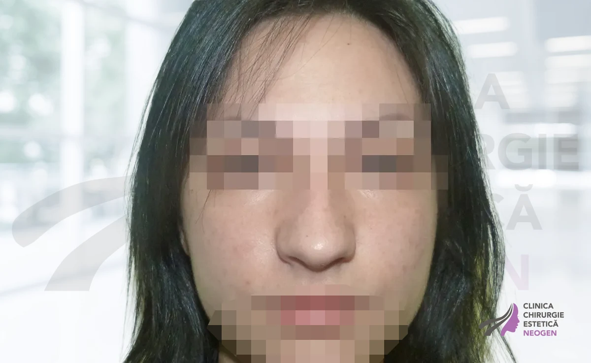Rinoplastie Înainte