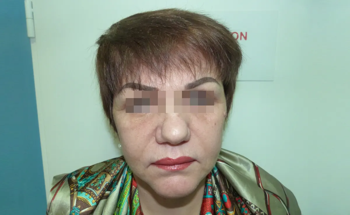 După