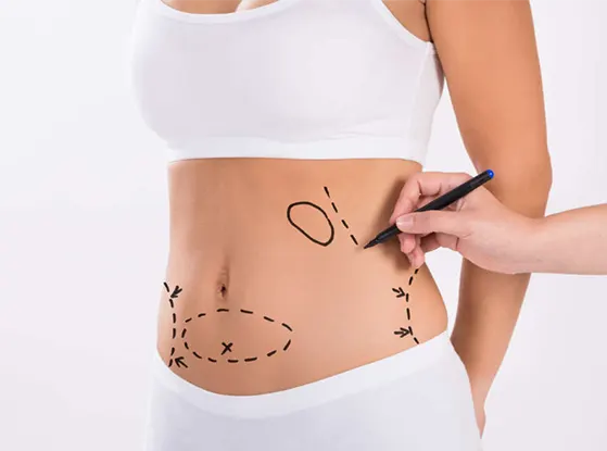 Abdominoplastie